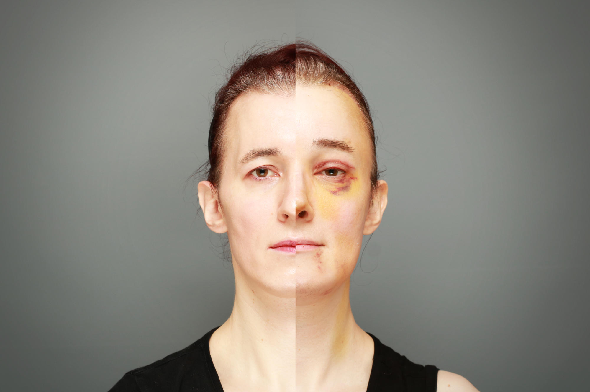 split frontal head shot, right side with scars, bruises, and changed facial features