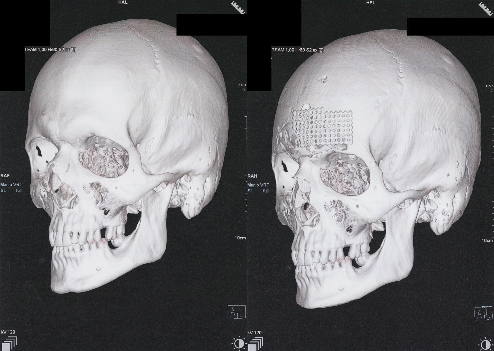 two 3D CT scans of a skull, left-side angled view