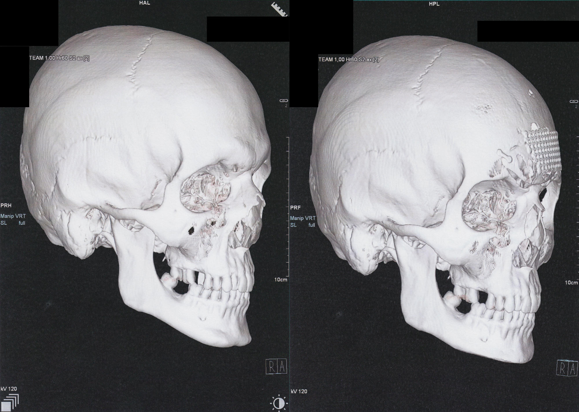 two 3D CT scans of a skull, right-side angled view