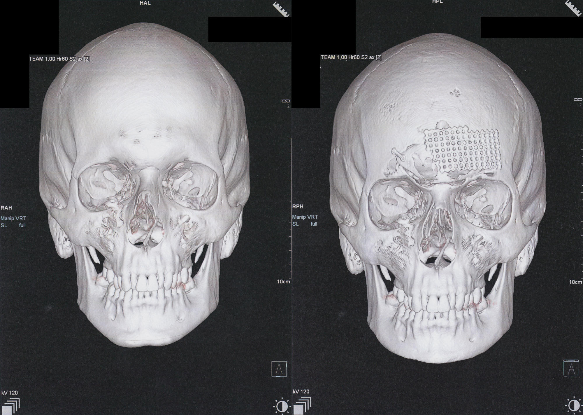 two 3D CT scans of a skull, frontal view