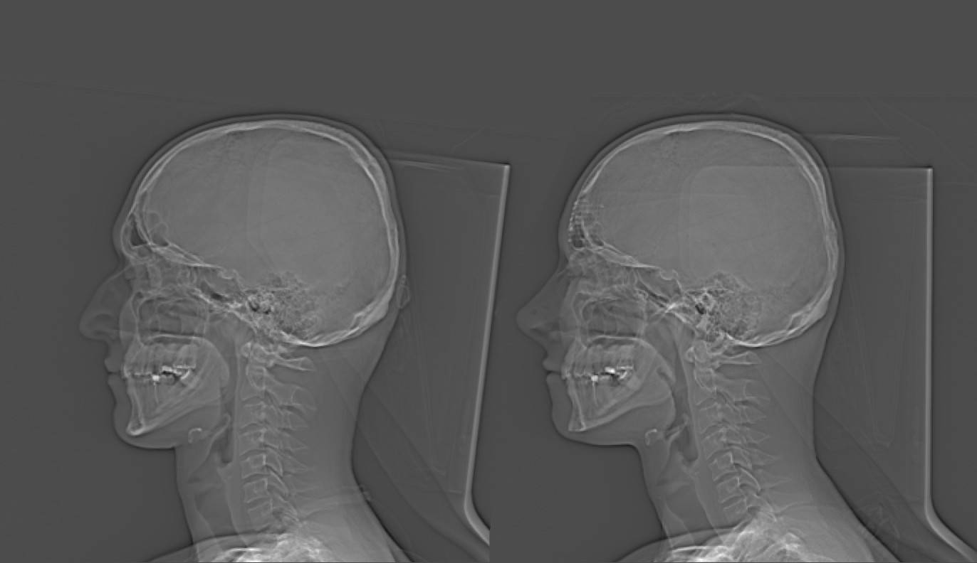 two 2D CT scans of a head, left side view, showing bone and tissue with significant differences