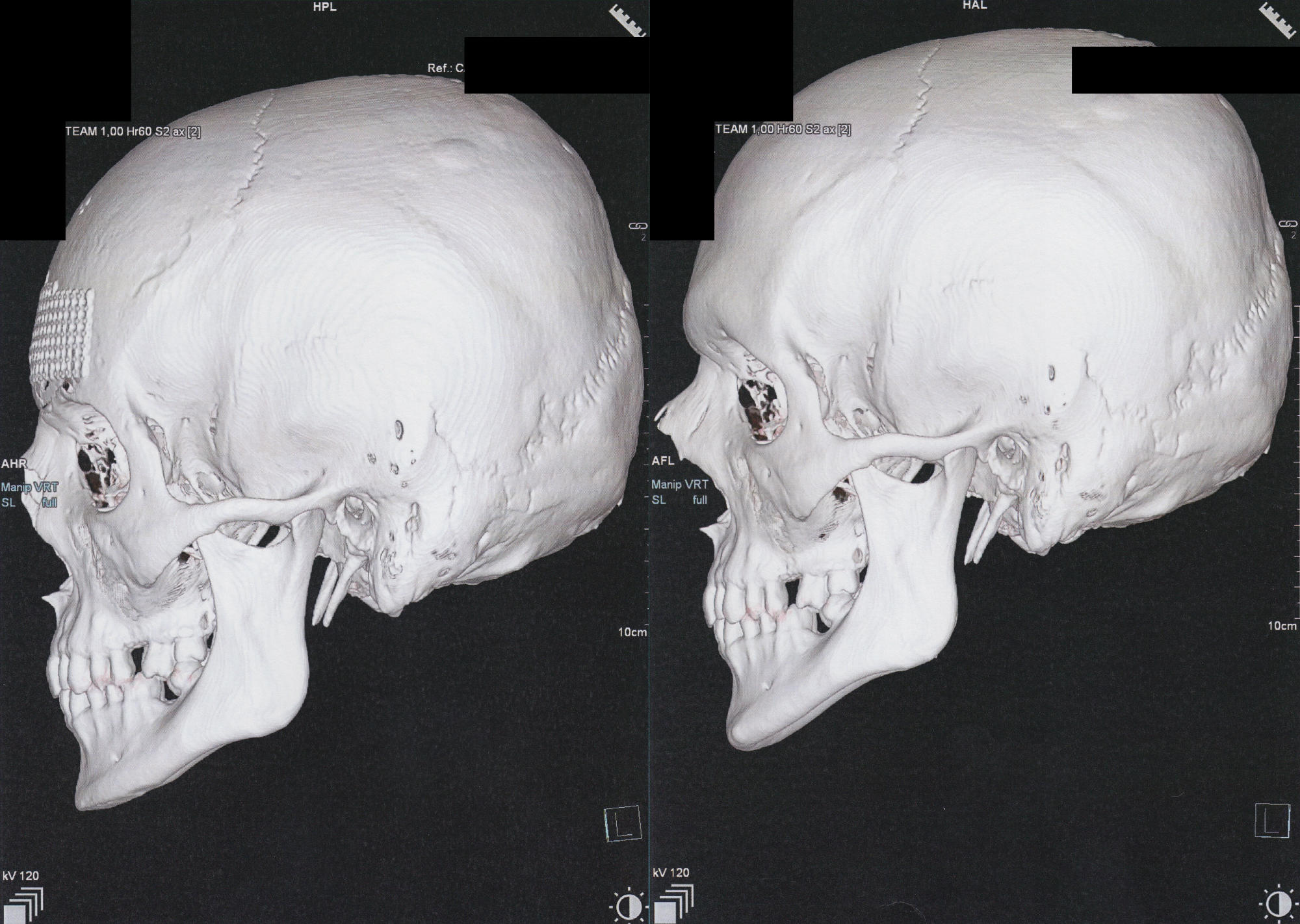 two 3D CT scans of a skull, left-side view