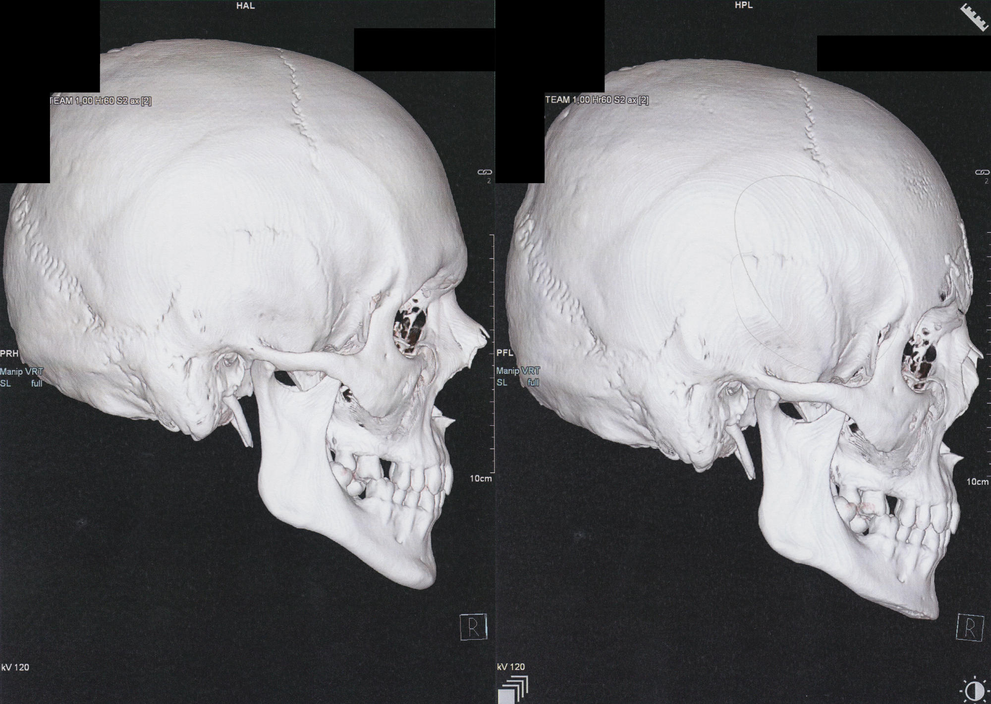 two 3D CT scans of a skull, right-side view
