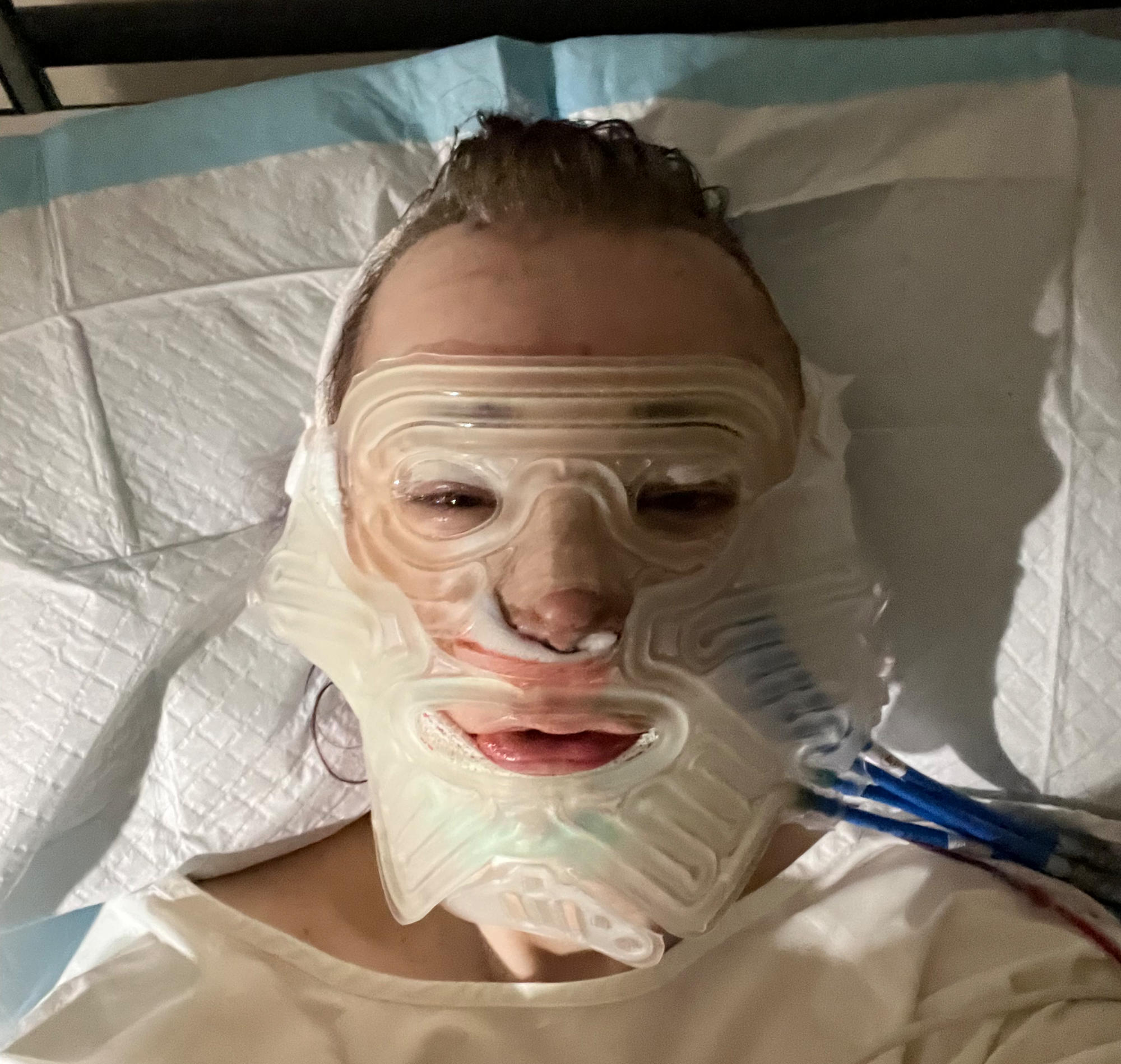 selfie in a hospital bed, wearing a cooling mask with water hoses attached, heavily swollen and bruised