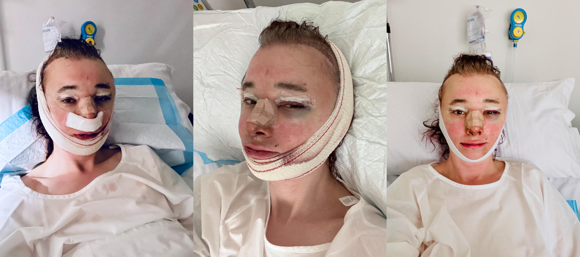 three selfies, sitting in a hospital bad, bandaged head, swollen and bruised