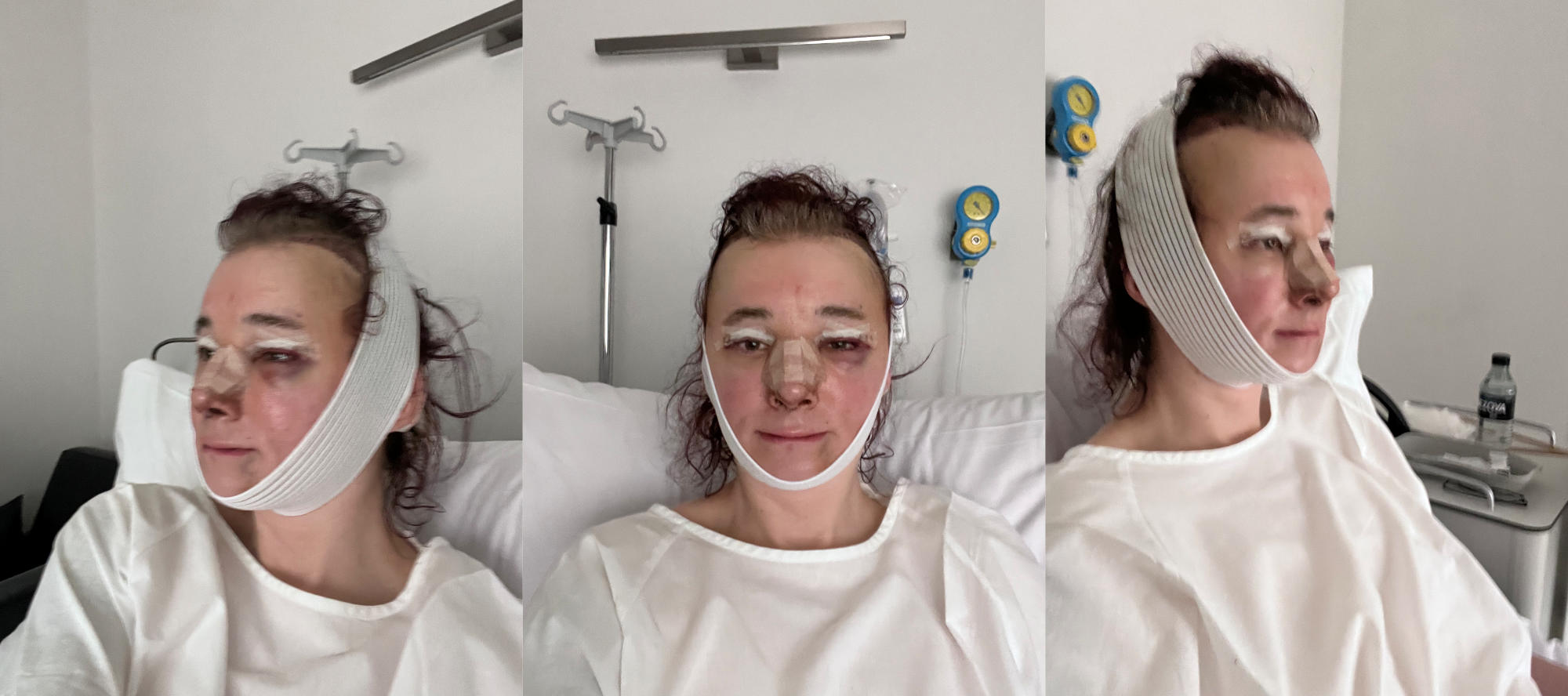three selfies, sitting in a hospital bad, bandaged head, swollen and bruised