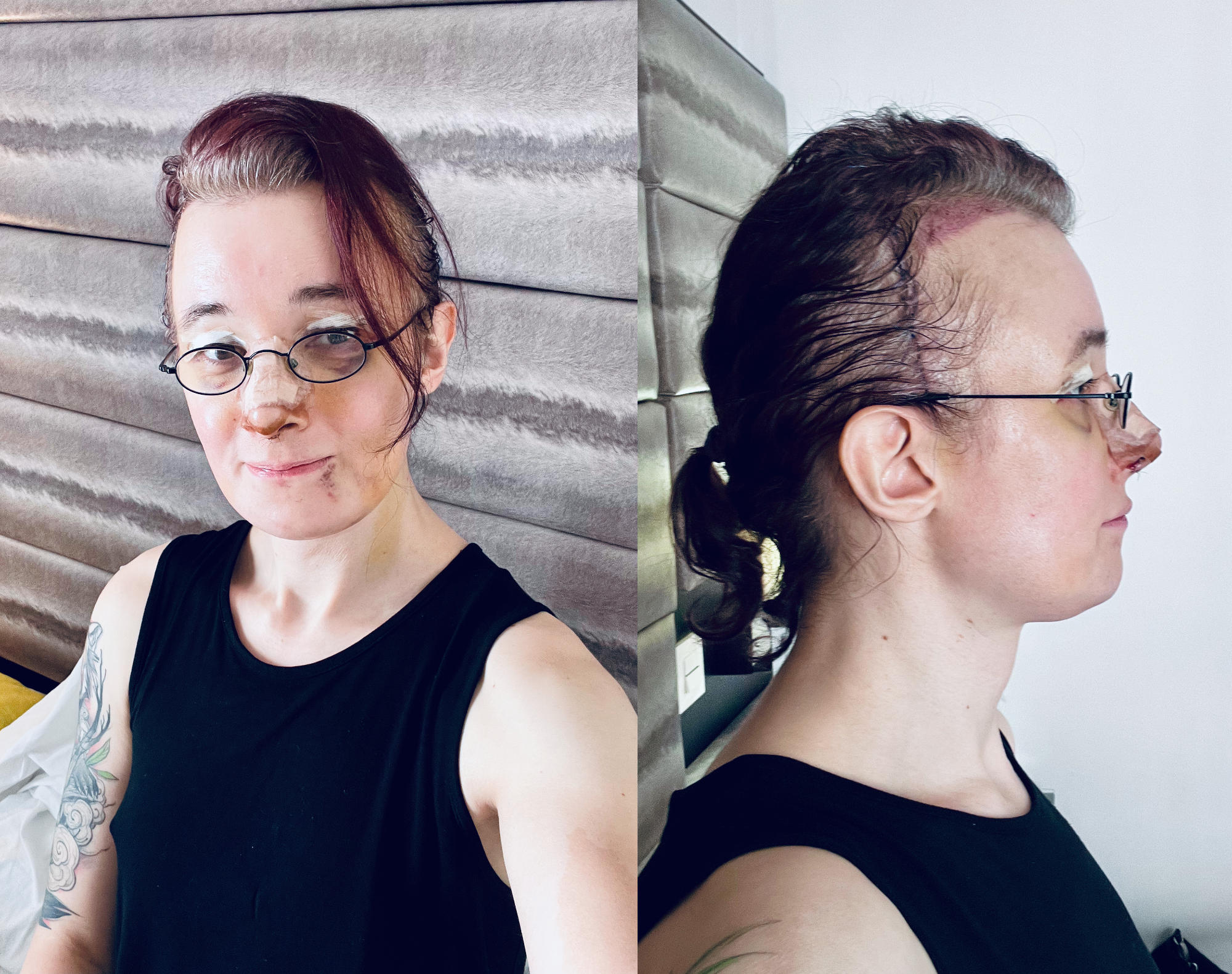 two photos: selfie with far less messy hair than before and a side profile shot that clearly shows the scar under my hair