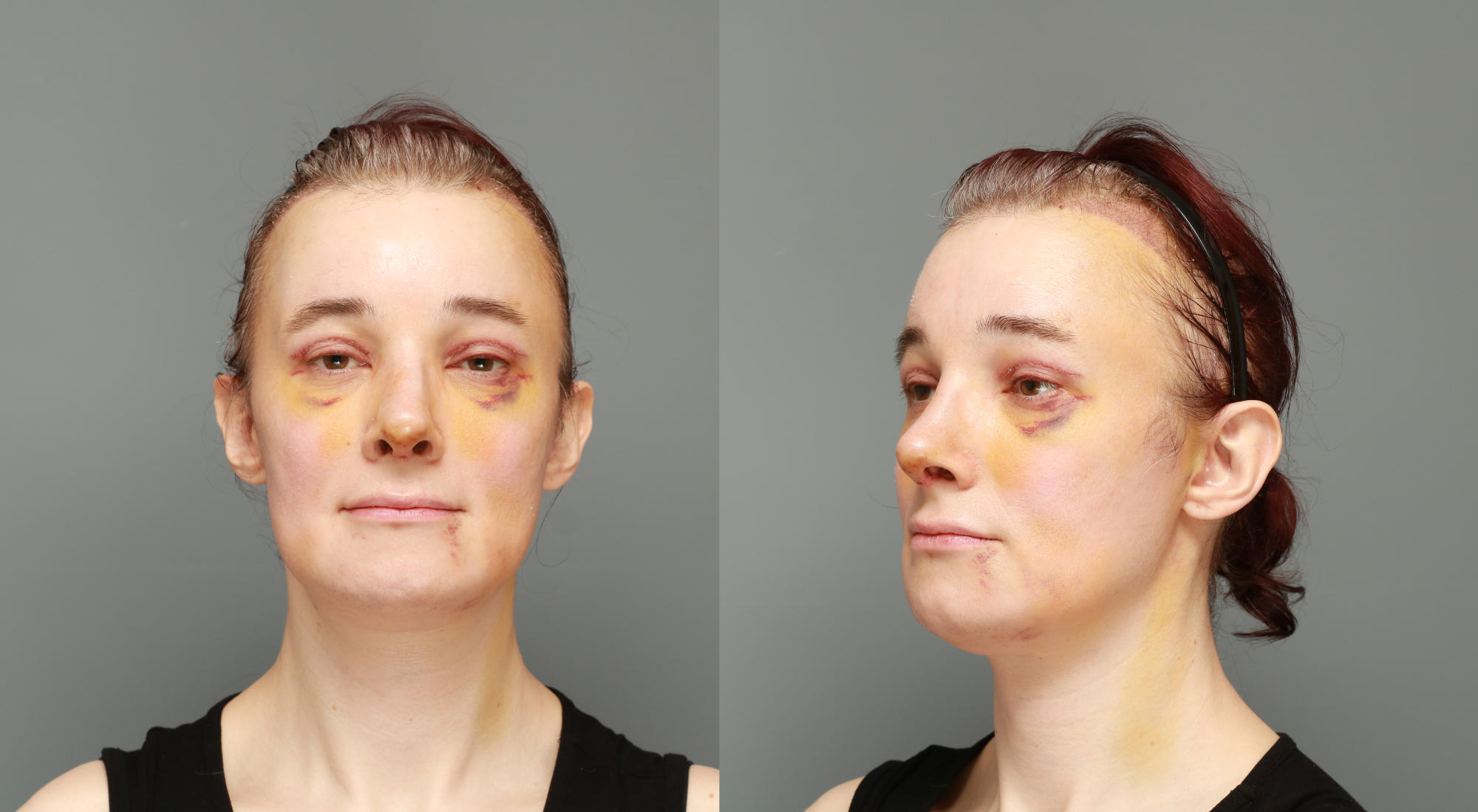 Two studio shots, front and slightly from the side, face is still bruised, nose is significantly different than before